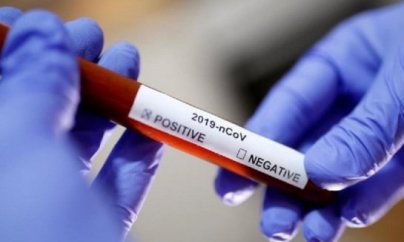 Azərbaycanda 33 nəfər koronavirusa yoluxdu, 3 nəfər öldü 