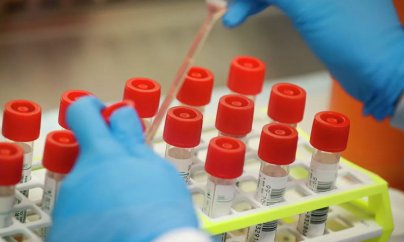 Azərbaycanda 257 nəfər koronavirusa yoluxdu