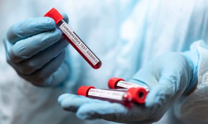 Azərbaycanda 47 nəfərin koronavirusa yoluxduğu bildirilir