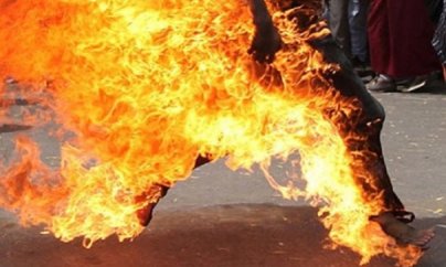 İntihara cəhd edən qazinin bədəninin 70 faizi yanıb