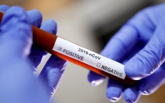 Azərbaycanda 33 nəfər koronavirusa yoluxdu, 3 nəfər öldü 